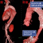 大動脈解離