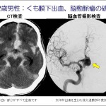 くも膜下