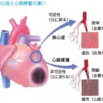 心筋梗塞