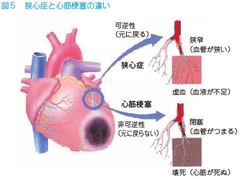 心筋梗塞