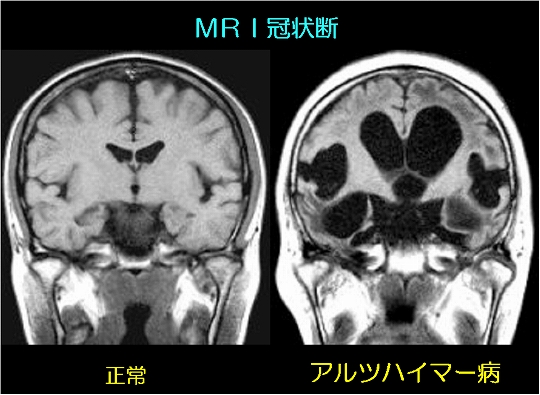 アルツハイマー